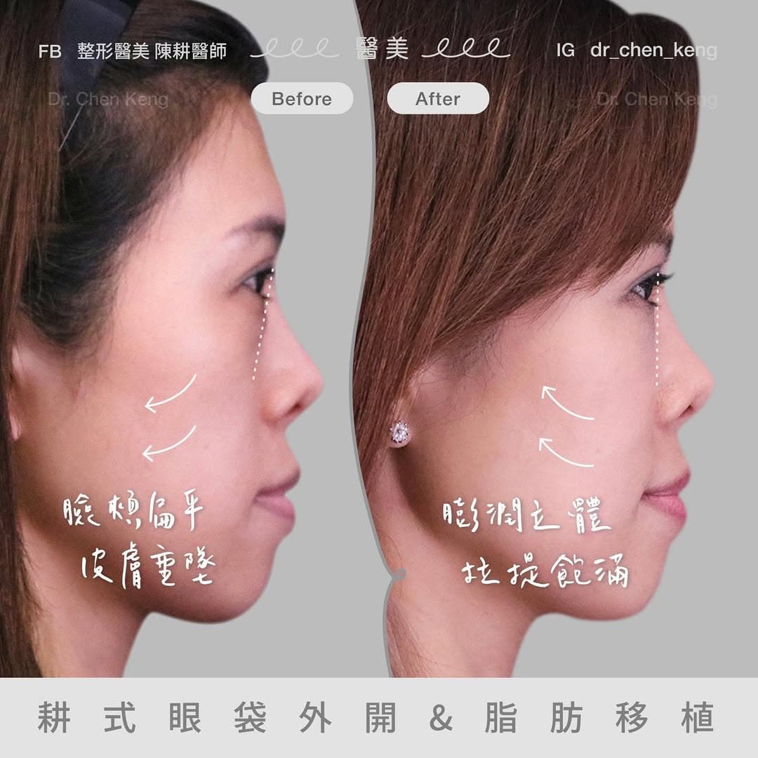 外開眼袋補脂